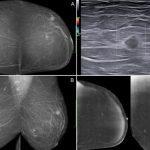 analiza porownawcza piersi 150x150 - WEBINAR: Soractelite - leczenie przerostu prostaty