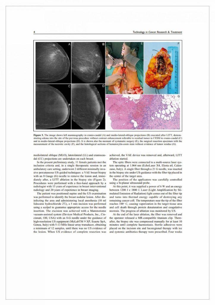 biopsja fuzyjna a aspiracyjna analiza porownawcza 04 04 scaled 724x1024 - Biopsja aspiracyjna i ablacja laserowa w przypadku zmian piersi - analiza porównawcza